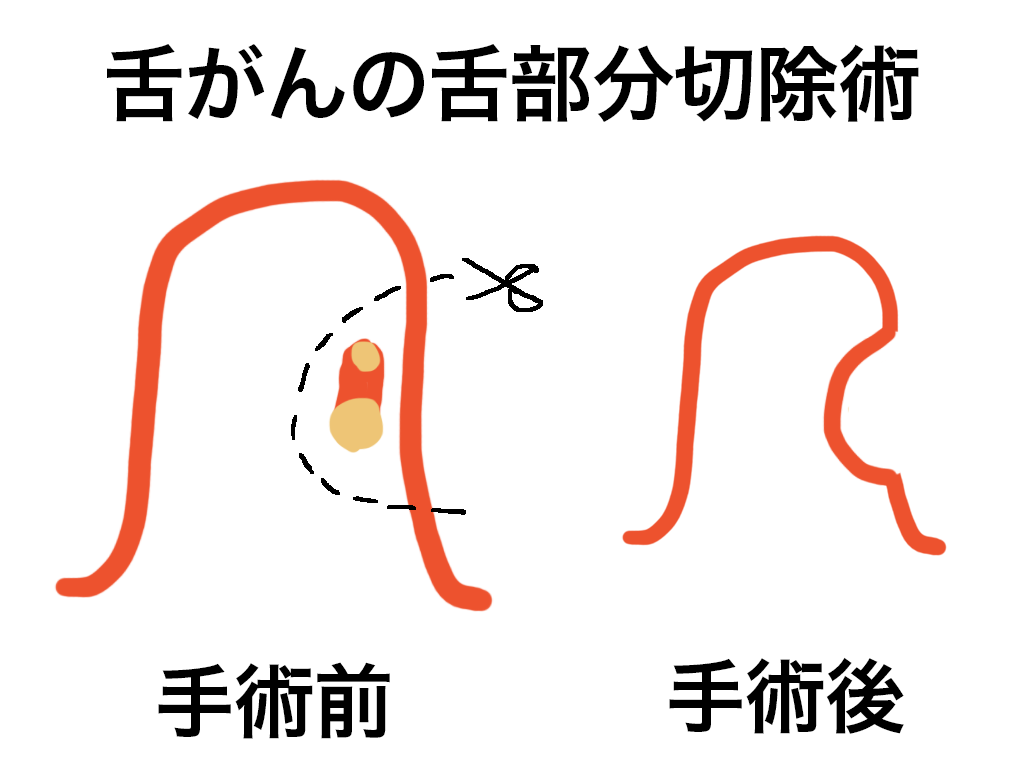舌部分切除術